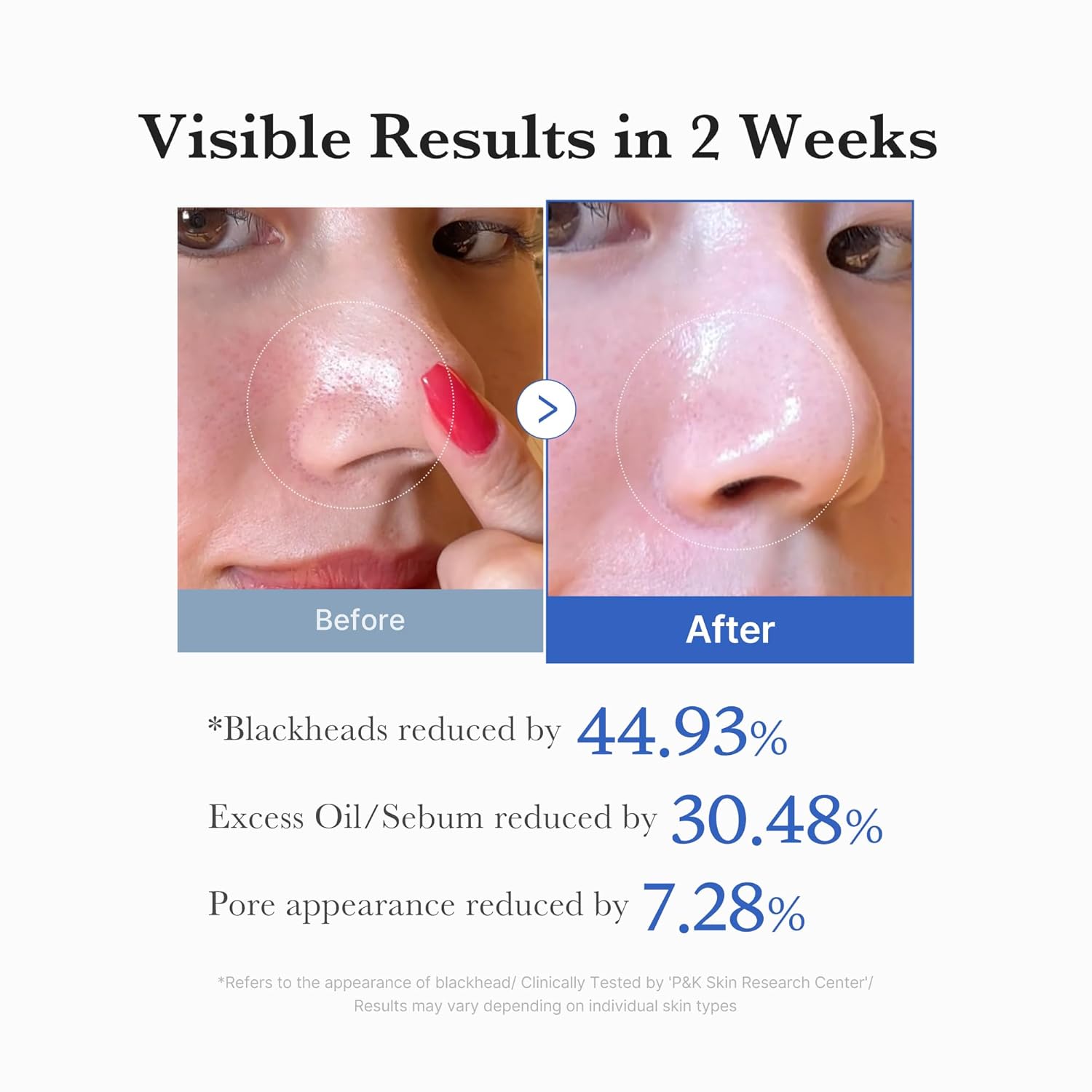 Clinical pore and sebum before and after results of Medicube Zero Pore Pad 2.0